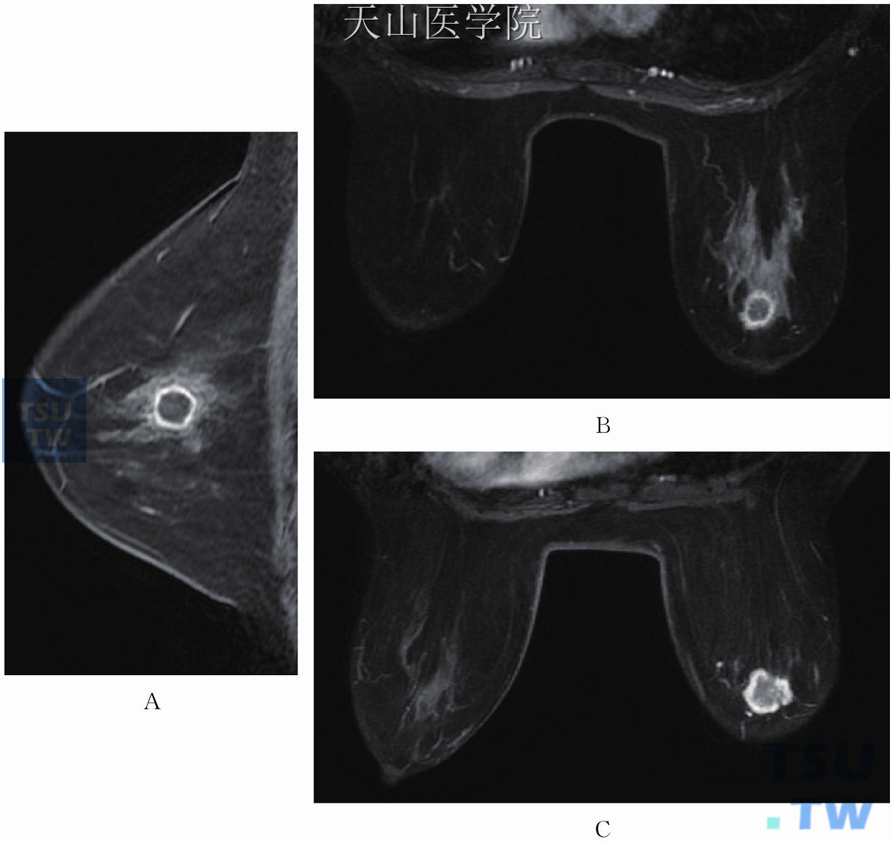 环形强化。（A）左乳外上囊肿伴感染，周围腺体组织为乳腺病，病灶区导管上皮非典型增生；（B）右乳为起源于微腺体的浸润性癌；（C）右乳外上浸润性导管癌