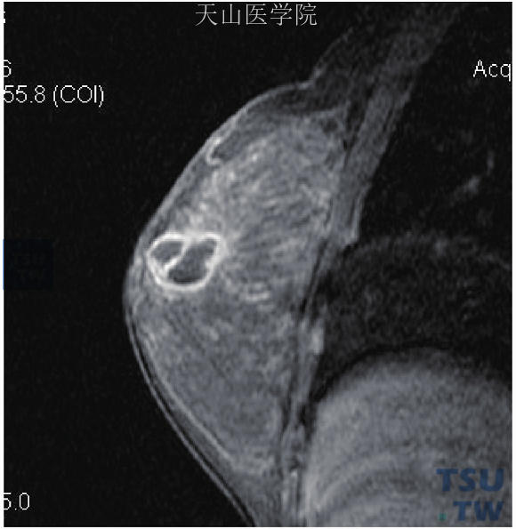 肿块内分隔强化