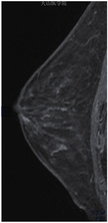乳腺病的线样导管样强化