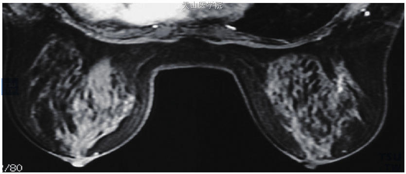 导管分支样不均匀强化，病理检查为右乳导管原位癌伴微浸润