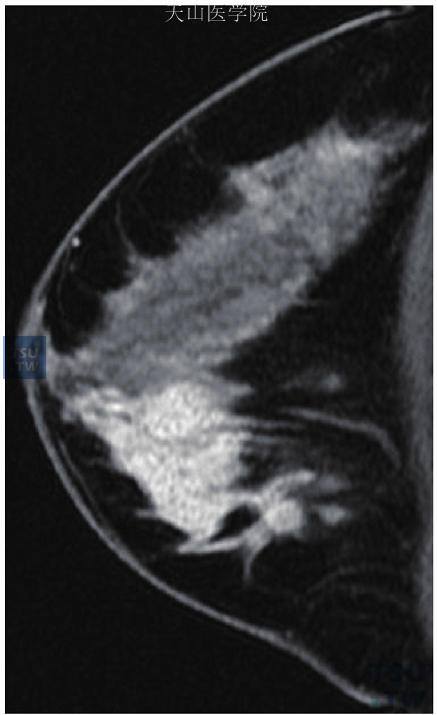 段样分布的病灶，成簇小环形强化，病理检查为左乳导管原位癌伴灶性浸润