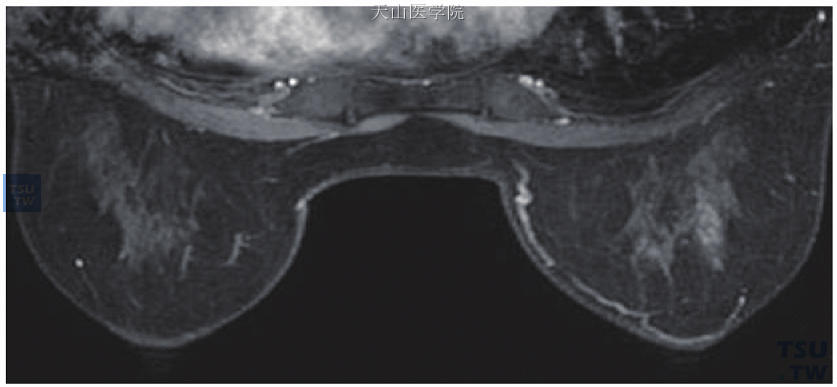 局灶性病灶，丛状强化，病理检查为右乳导管原位癌