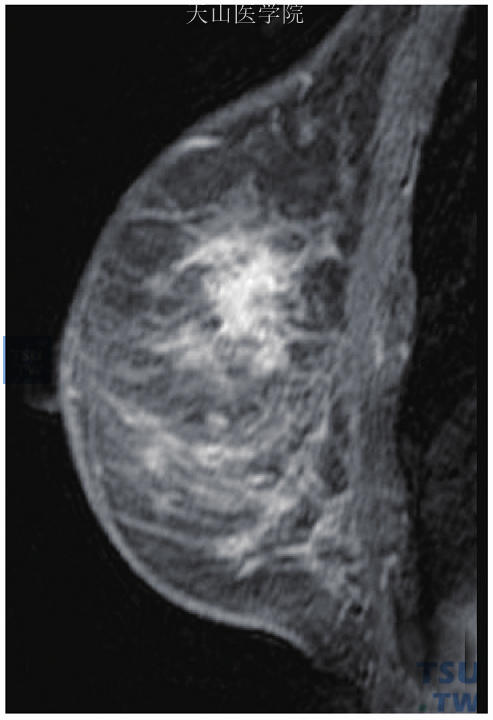 区域性不均匀强化，病理检查为右乳导管原位癌伴微浸润