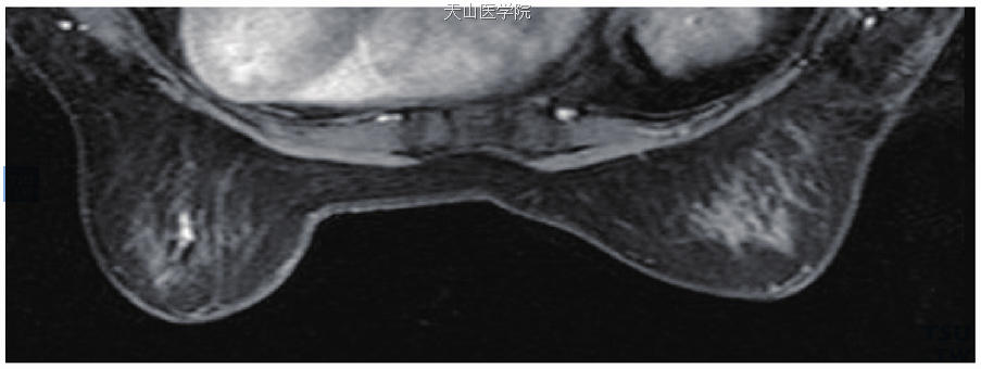 斑点状病灶，均匀强化，病理为左乳导管原位癌