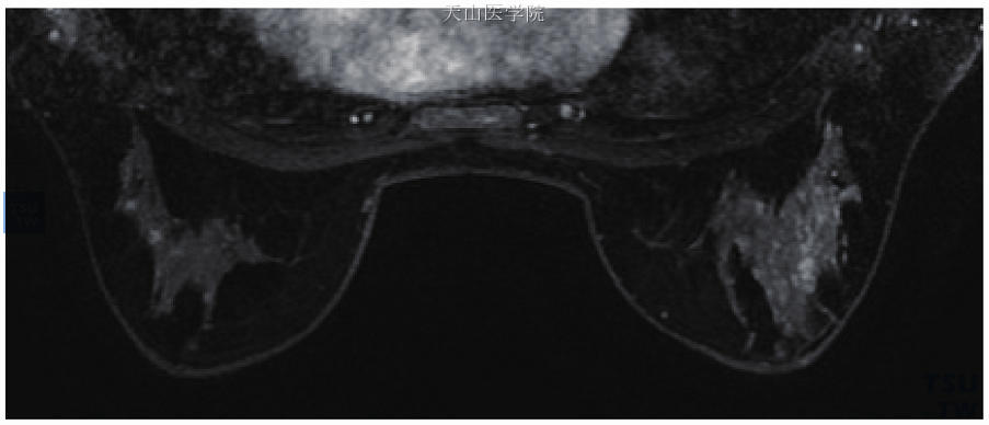 点状簇强化，右乳乳腺病伴导管扩张