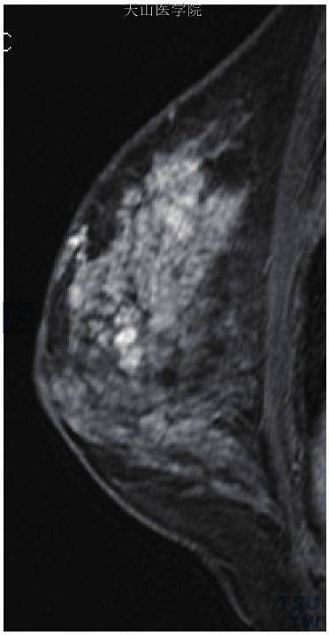 卵石样强化，左乳浸润性导管癌，周围见导管原位癌