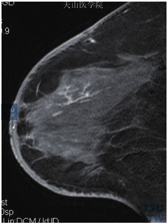 网状/树突状强化，左乳导管原位癌，以导管分支样分布的网状强化