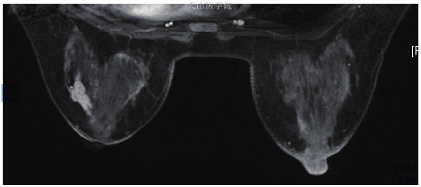 簇状小环形强化，左乳以导管原位癌为主的浸润性导管癌