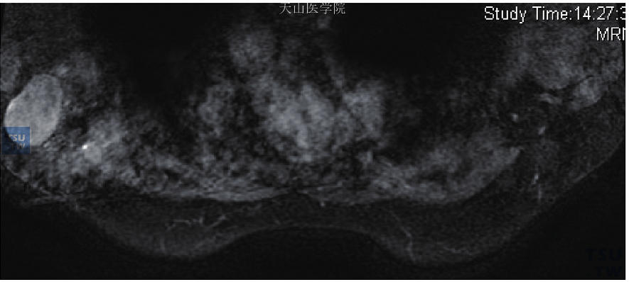 腋窝淋巴结肿大，左乳隐匿性乳腺癌伴左腋窝淋巴结转移