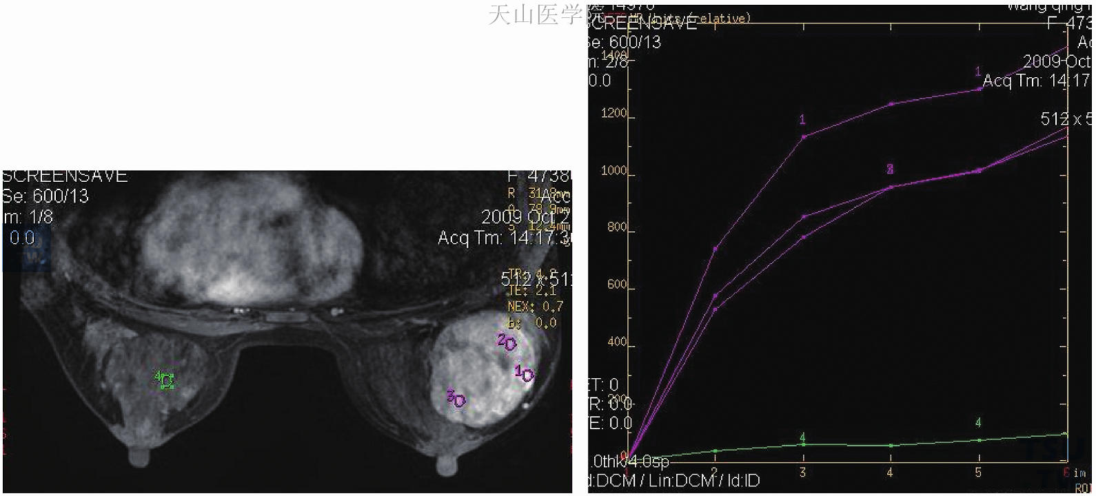 左乳分叶状肿瘤，持续上升型曲线