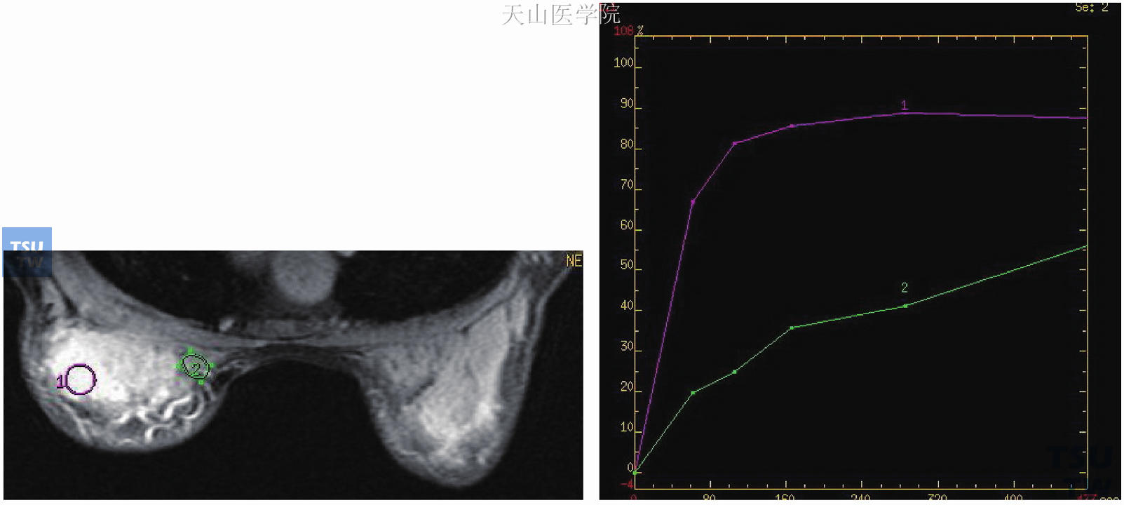 左乳浸润性导管癌，平台型曲线