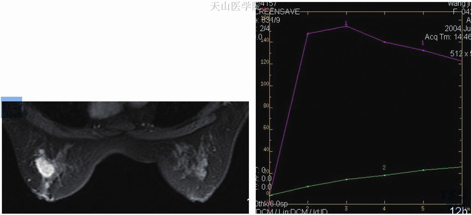 左乳纯原位导管癌，廓清型曲线