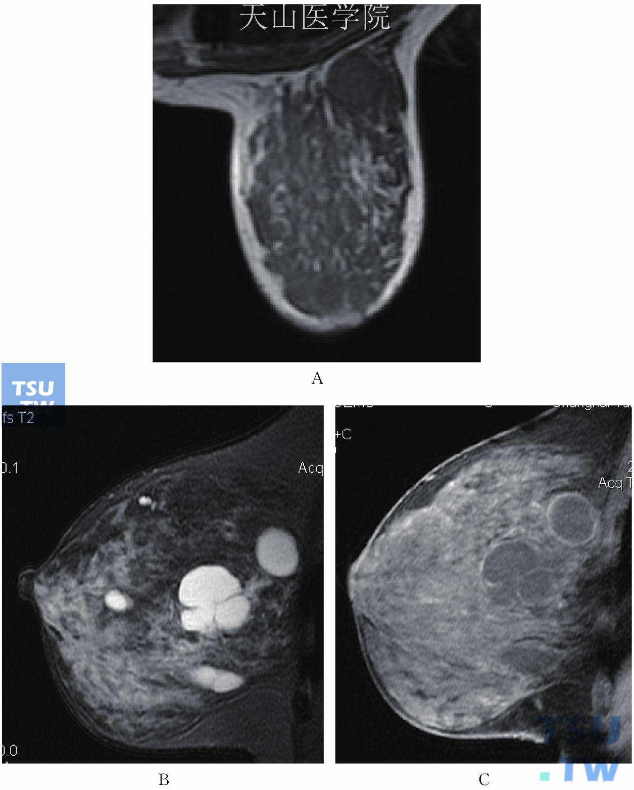 【厦门高尚医学影像】磁共振在乳腺癌早期筛查中的作用