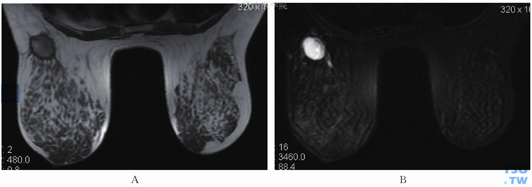 亚急性出血。左乳纤维腺瘤术后血肿，T1WI（A）、T2WI（B）均为高信号，周围均可见低信号的环