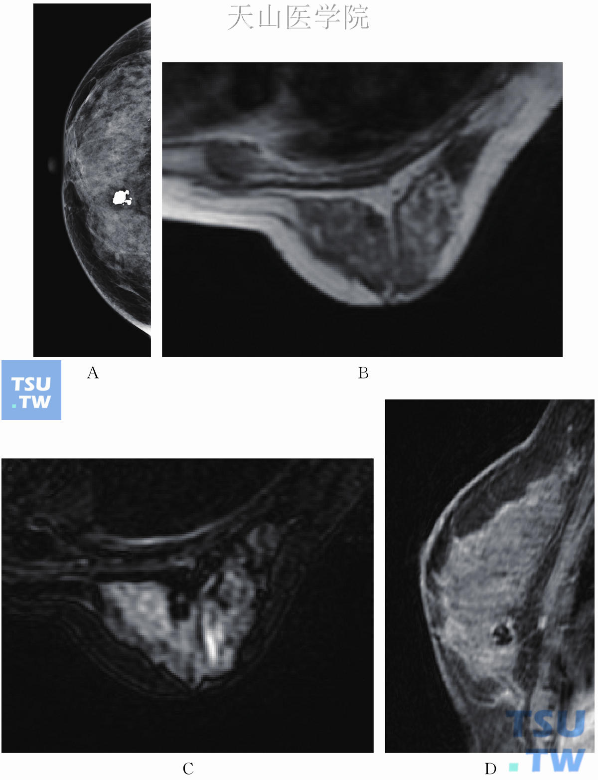 良性钙化。钼靶CC位示右乳内侧粗糙钙化（A），BI-RADS2，T1WI为低信号（B），T2WI为低信号（C），矢状位增强未见明显强化（D）