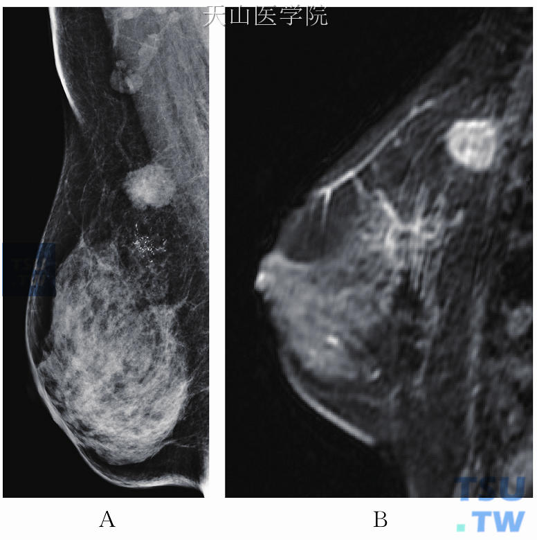乳腺常见病变的MRI表现