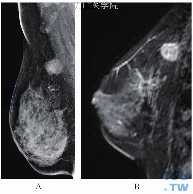 恶性钙化。左乳外上肿块为浸润性导管癌，钼靶所示钙化灶为导管原位癌，钼靶MLO位（A），MRI矢状位增强（B）。钼靶所示钙化的病灶范围较MRI所示范围小