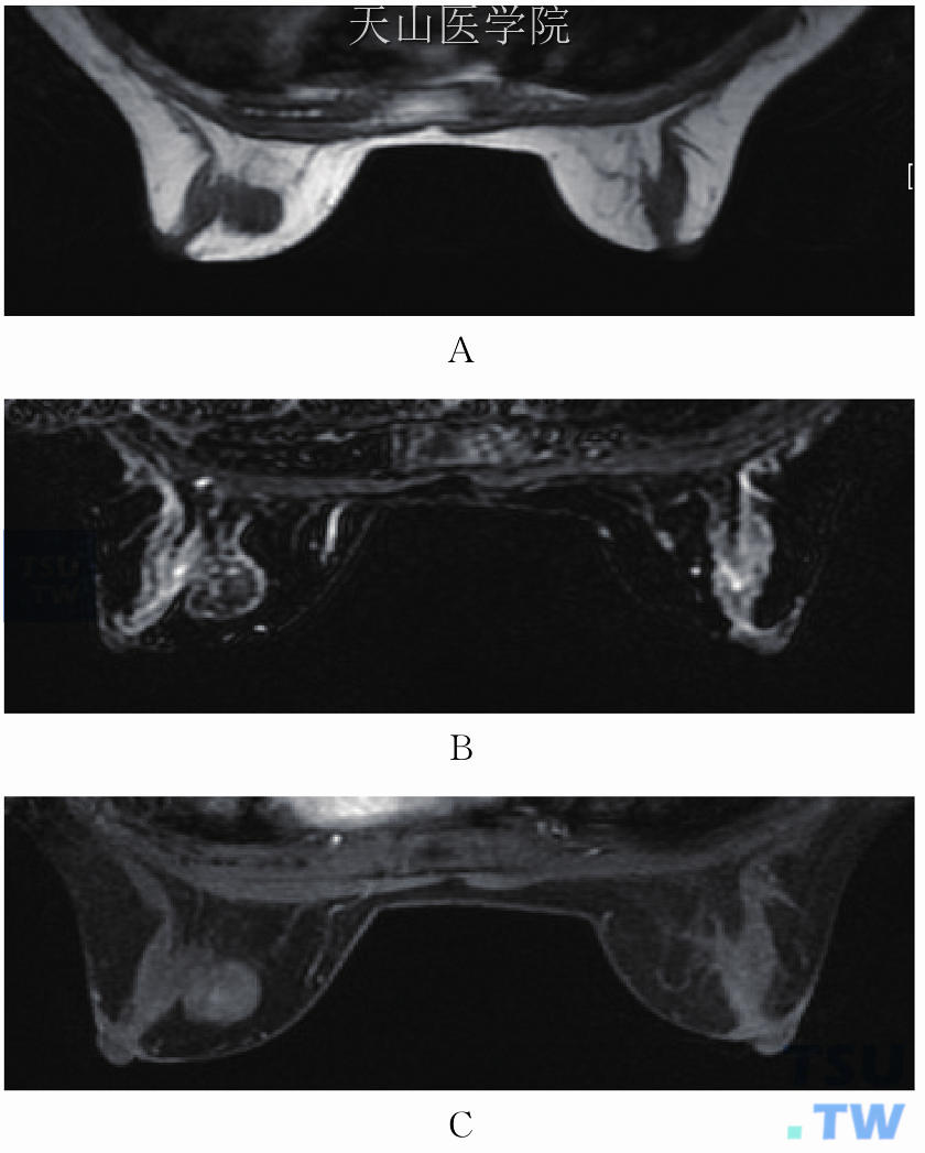左乳纤维腺瘤。T1WI低信号（A），T2WI低信号（B），增强后强化不明显（C）