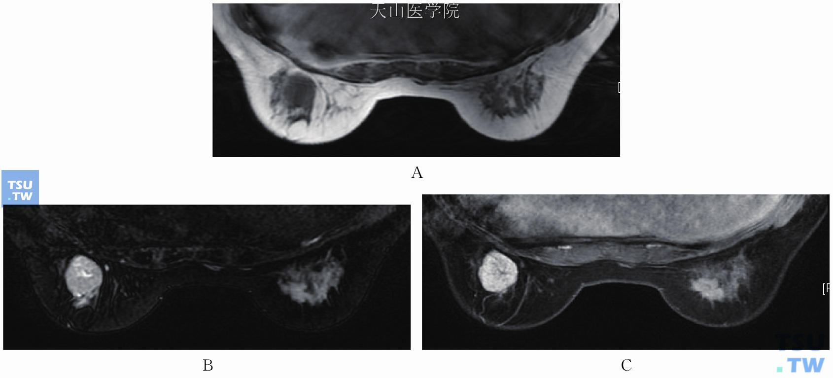 左乳腺管纤维腺瘤。T1WI低信号（A），T2WI高信号内见裂隙状更高信号（B），提示肿瘤内囊性，增强后明显均匀强化（C），囊变区无强化。右乳星芒状肿块，为浸润性导管癌