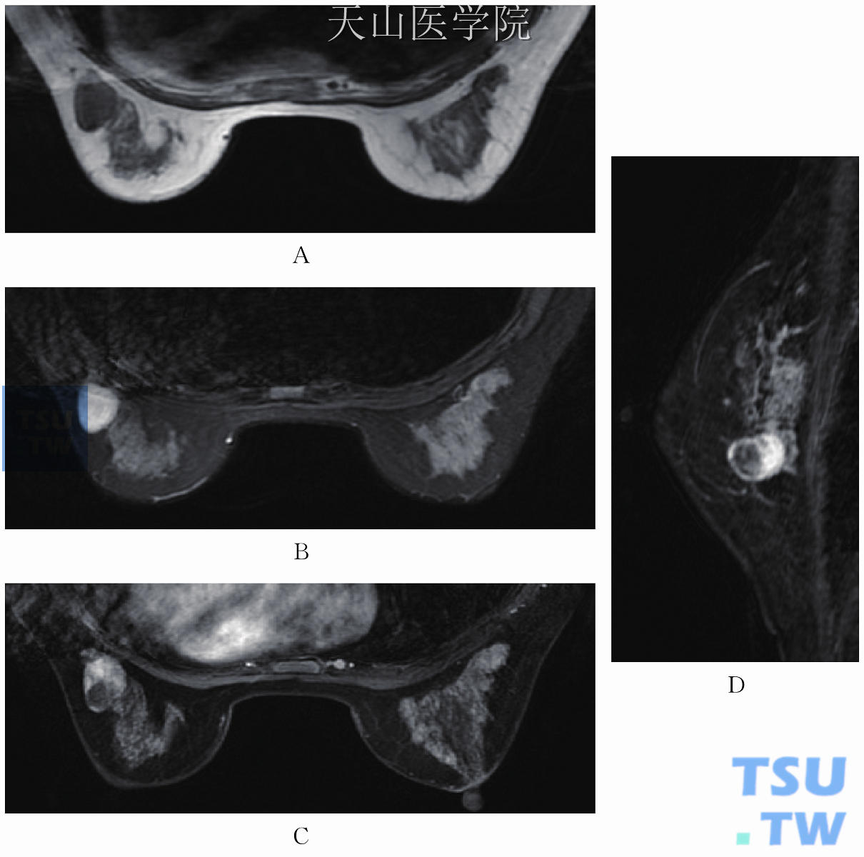 左乳纤维腺瘤。T1WI低信号（A），T2WI高信号（B），增强扫描（C、D）提示实性部分明显均匀强化，囊性部分不强化