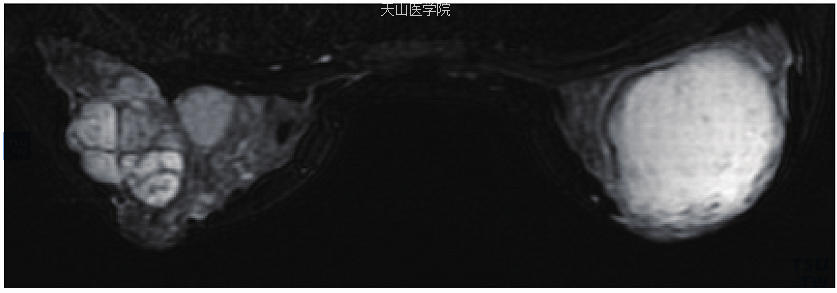 左乳纤维腺瘤，右乳梗死性纤维腺瘤：T2WI显示左乳高信号的肿块内可见低信号的分隔；右乳肿块高信号，边缘见低信号的环