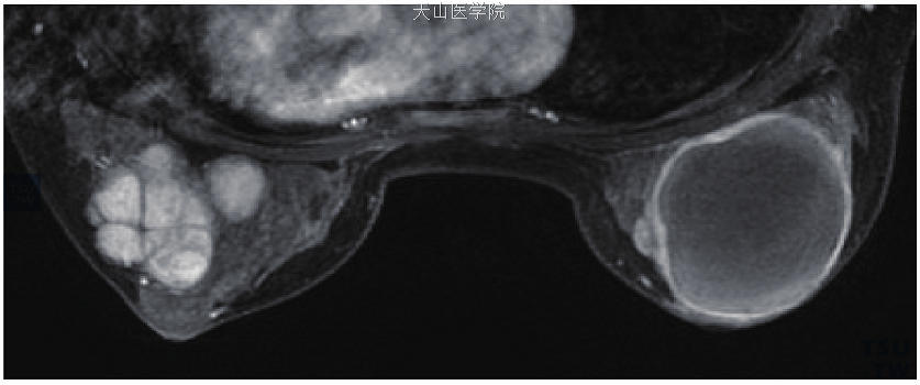 为图11-57患者增强图像，左乳低信号的分隔未见强化，右乳仅见边缘强化