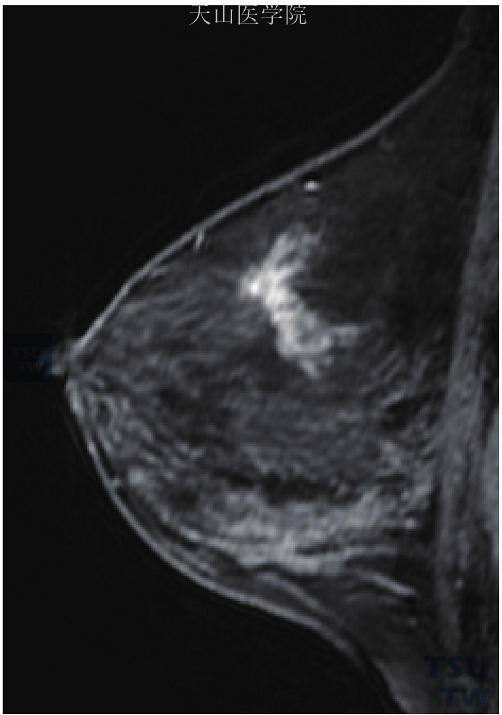 左乳乳腺病，左乳外上区域性非肿块样强化，病灶与腺体垂直
