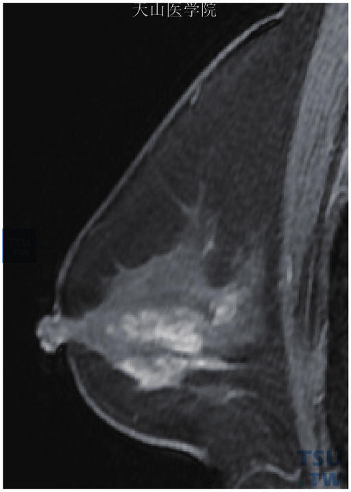 右乳乳腺病，呈区域性分布的非肿块样强化