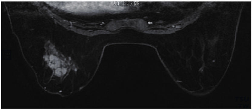 左乳乳腺病伴导管内乳头状瘤（周围型），导管上皮高度增生伴局部癌变，左乳晕后方多发小结节