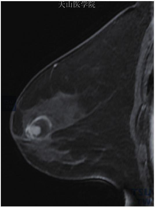 左乳导管内乳头状瘤，左乳晕后方圆形囊性结节伴囊内持续强化的小结节