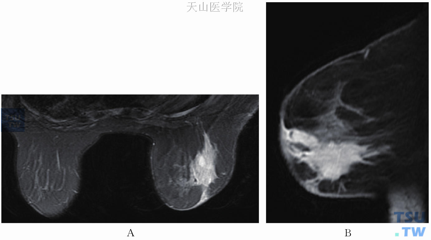 女孩左右两边胸大小不一样怎么办？ - 知乎