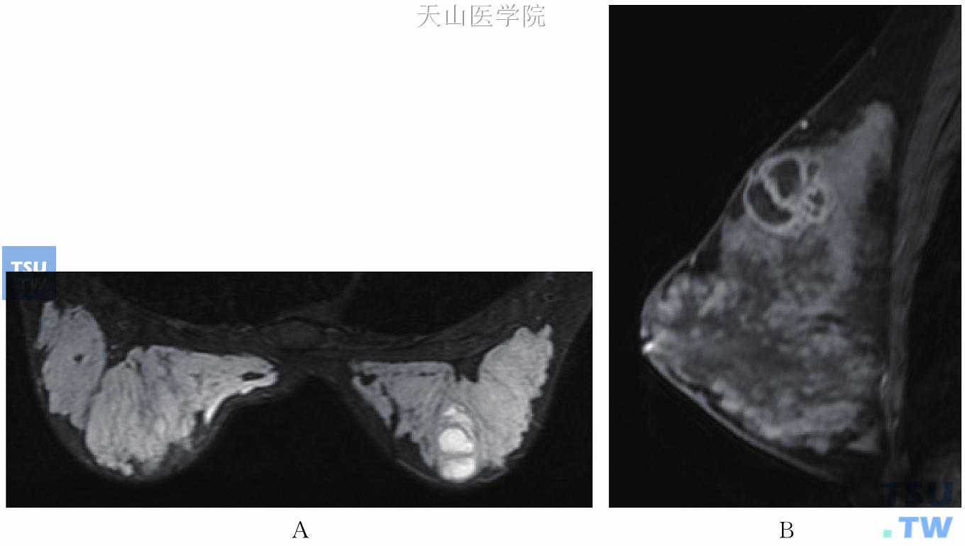 患者22岁，哺乳3个月，哺乳期乳腺炎伴脓肿形成。右乳内上肿块，T1WI低信号伴等信号的脓肿壁（未显示），T2WI高信号伴等信号的环（A）；增强后脓肿壁呈均匀的环形强化，中心坏死无强化（B）