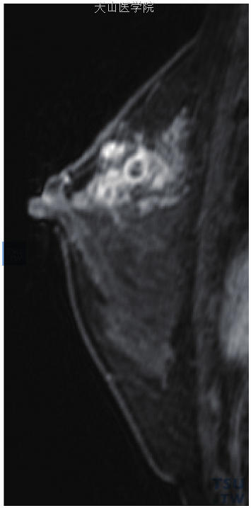 患者31岁，左乳急性化脓性乳腺炎。左乳外上段样分布的强化伴环形强化