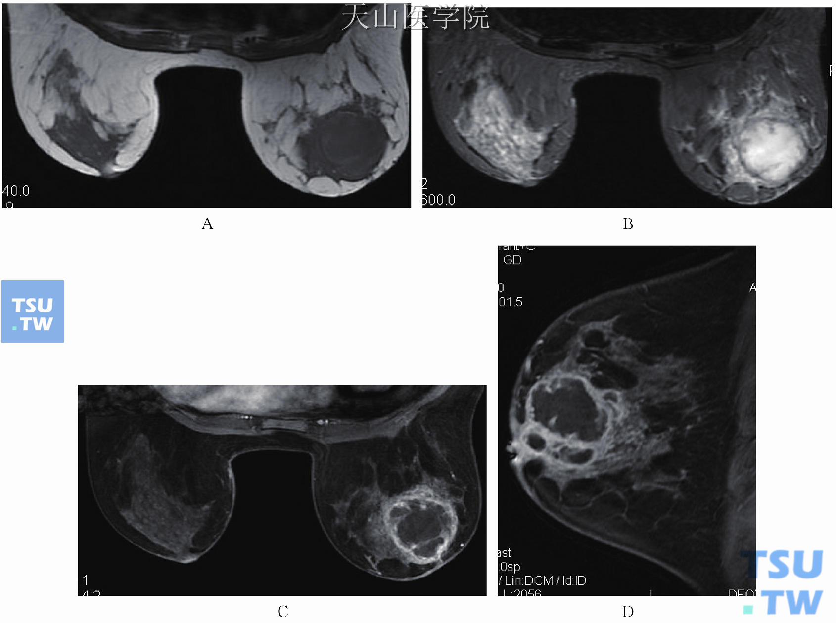 乳腺良性疾病的MRI表现