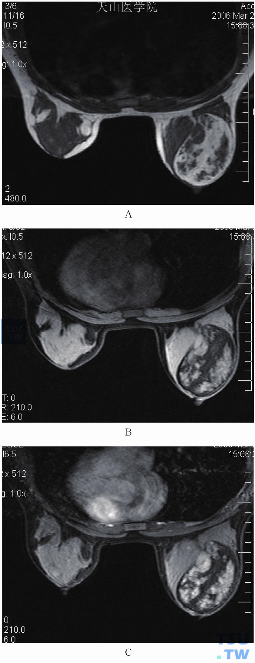 右乳外侧错构瘤。（A）T1WI示右乳外侧椭圆形肿块，内见片状高信号；（B）抑脂T2WI显示T1WI为高信号的脂肪信号被抑制，呈低信号；（C）增强后肿块内呈片状强化，脂肪成分不强化