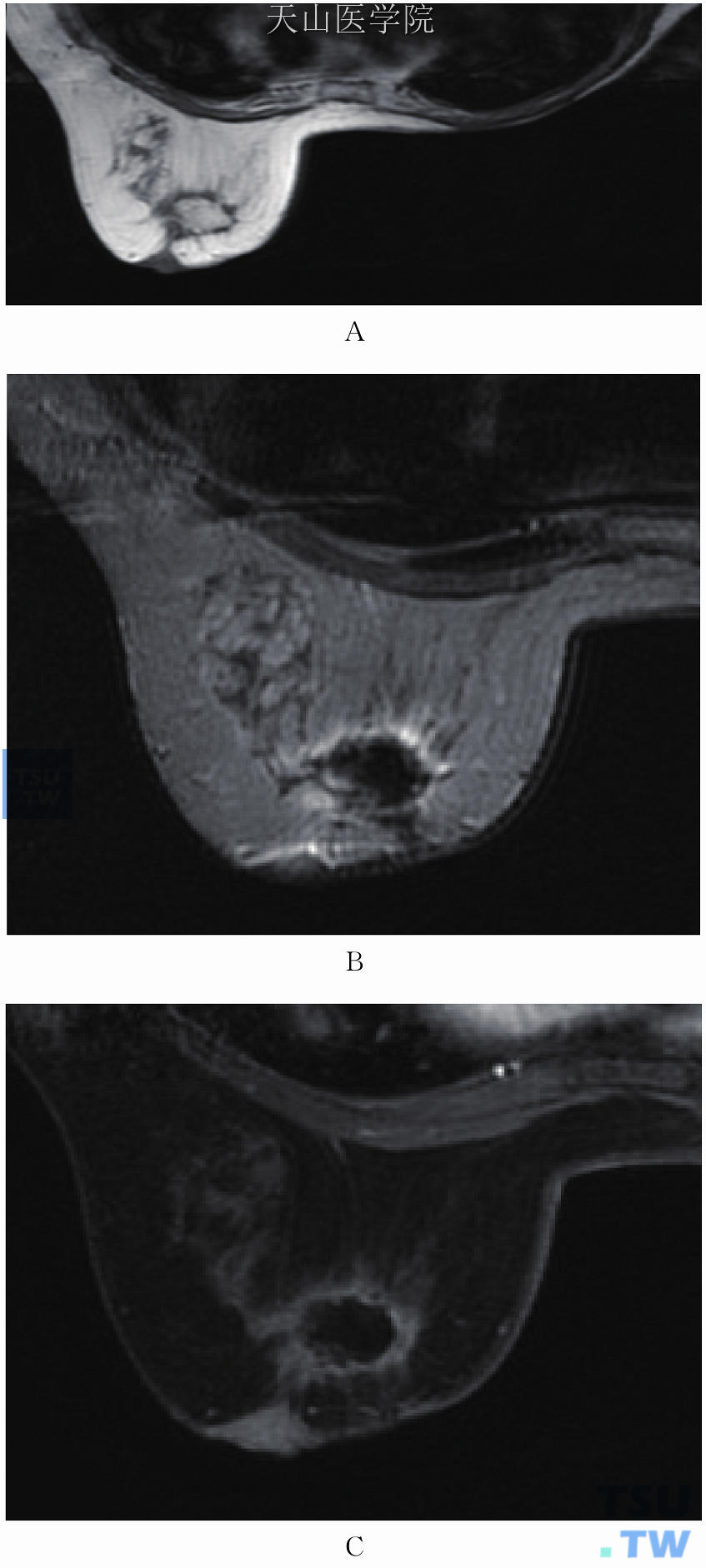 右乳腺癌、左乳乳腺病术后，左乳内上占位性病灶。（A）T1WI病灶为高信号；（B）T2WI呈低信号；（C）增强后环形强化