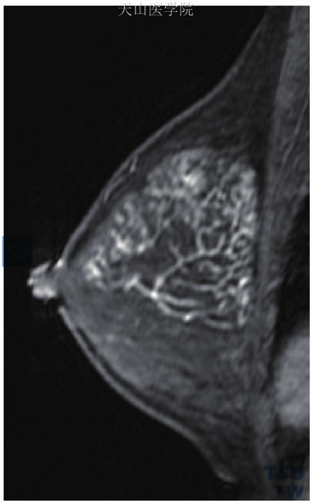 为MRI矢状位增强，左乳外上段样分布强化，勾勒出左乳外上的导管形态。病理检查为左乳导管原位癌，高级别