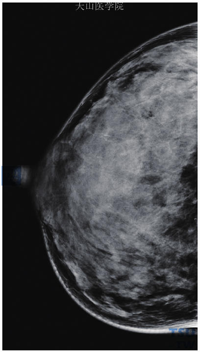 为图11-70的同一患者左乳CC位，钼靶显示左乳为多量腺体型乳房，乳内未见明显恶性证据