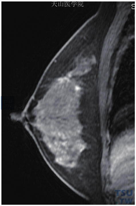 右乳浸润性导管癌，矢状位增强见星芒状病灶