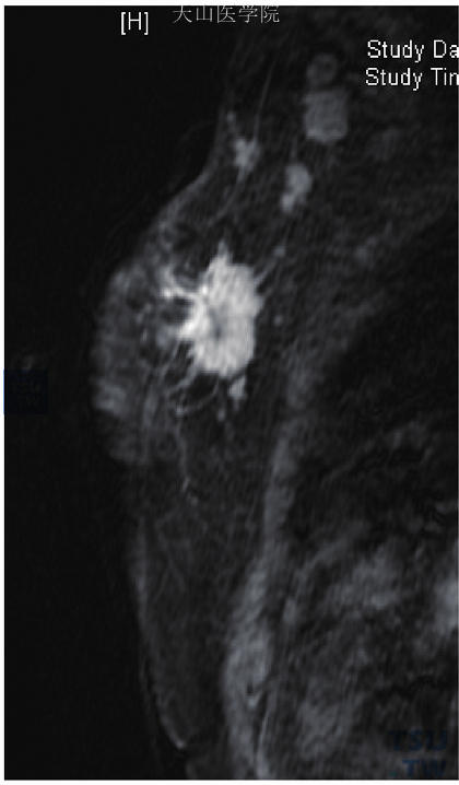 右乳浸润性导管癌，矢状位示肿块有分叶及毛刺，腋下见肿大淋巴结