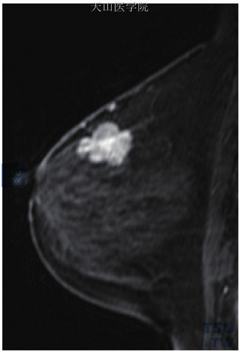 右乳浸润性导管癌，部分呈浸润性微乳头状癌，矢状位增强见分叶状肿块