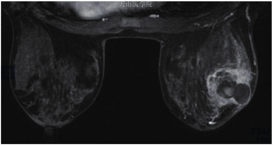 右乳浸润性导管癌，轴位示肿块呈环形强化，壁厚薄不均匀