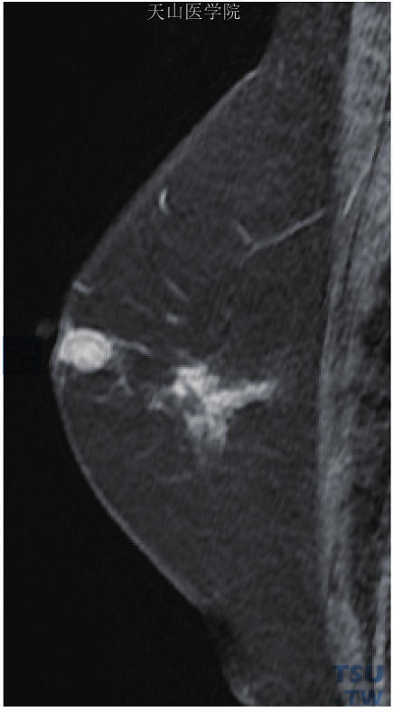 左乳浸润性导管癌，矢状位示左乳晕外侧肿块伴后方区域性非肿块样强化