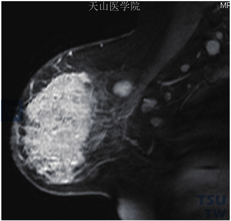 右乳浸润性导管癌，矢状位示右乳弥漫性强化伴右腋窝多发淋巴结肿大