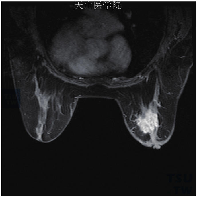 右乳浸润性小叶癌，轴位增强示右乳晕后方肿块，边缘不规则，强化不均匀