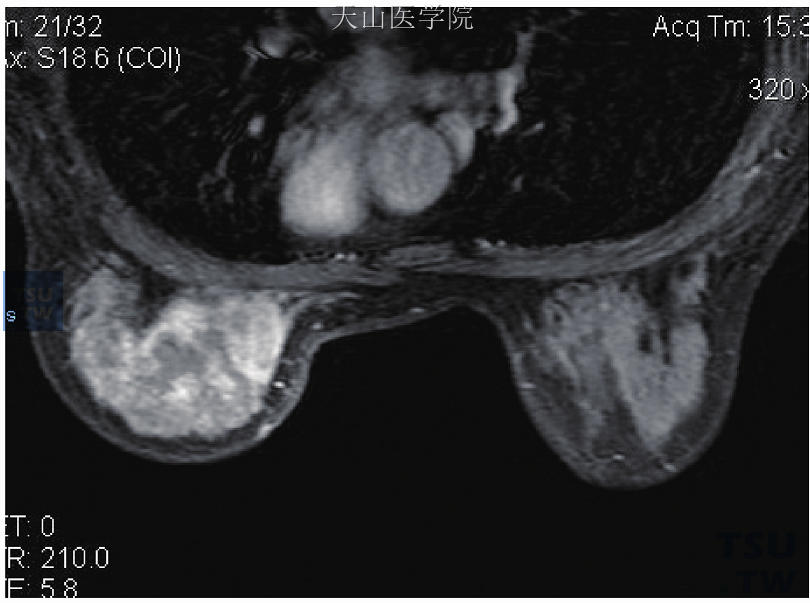 左乳浸润性小叶癌，轴位增强示左乳上方区域性强化，强化不均匀