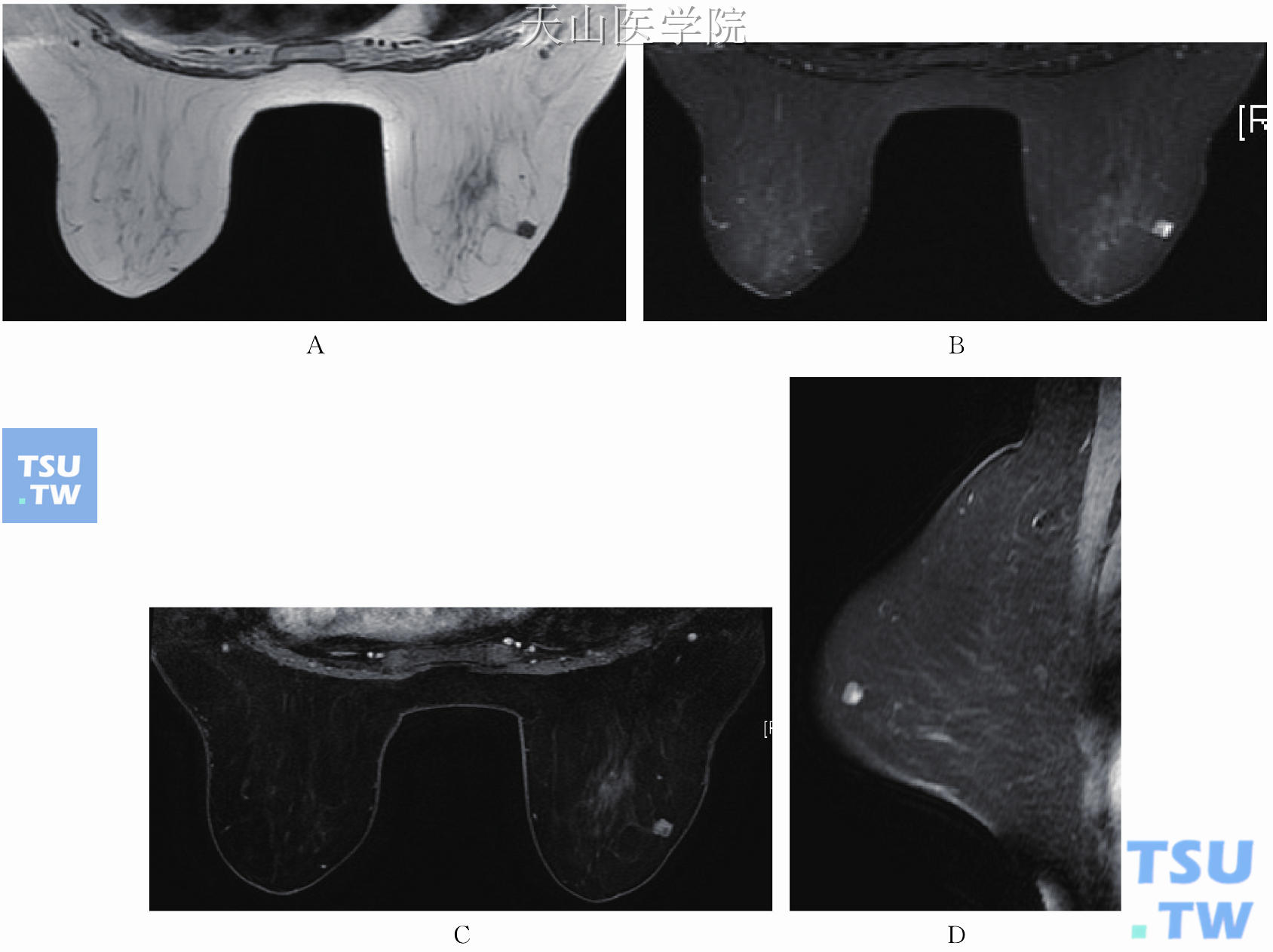右乳外上黏液腺癌。（A）T1WI低信号；（B）T2WI不均匀高信号；（C、D）实性部分呈结节状延迟强化