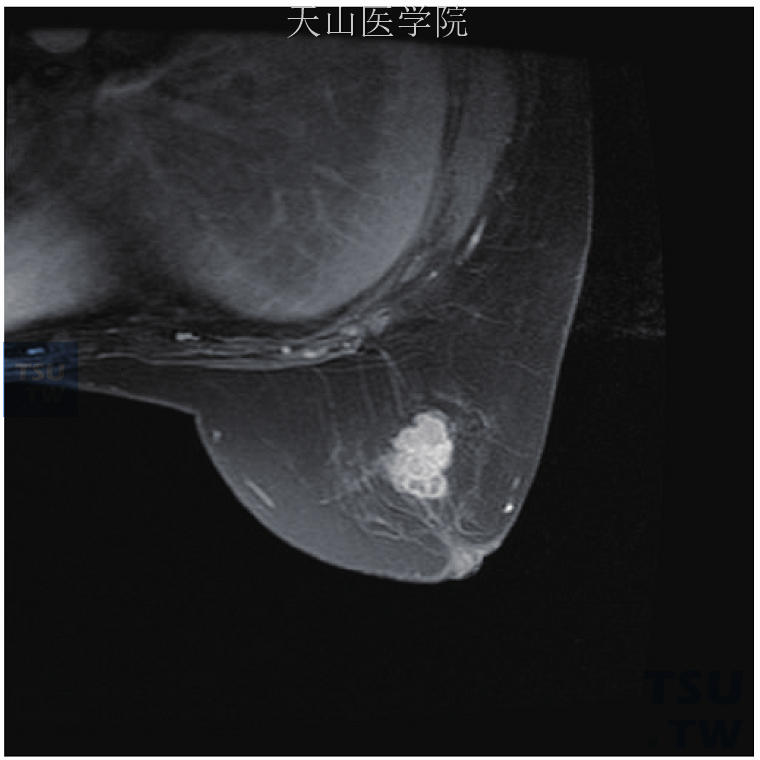 右乳髓样癌。轴位增强显示右乳晕后方分叶状肿块，不均匀强化