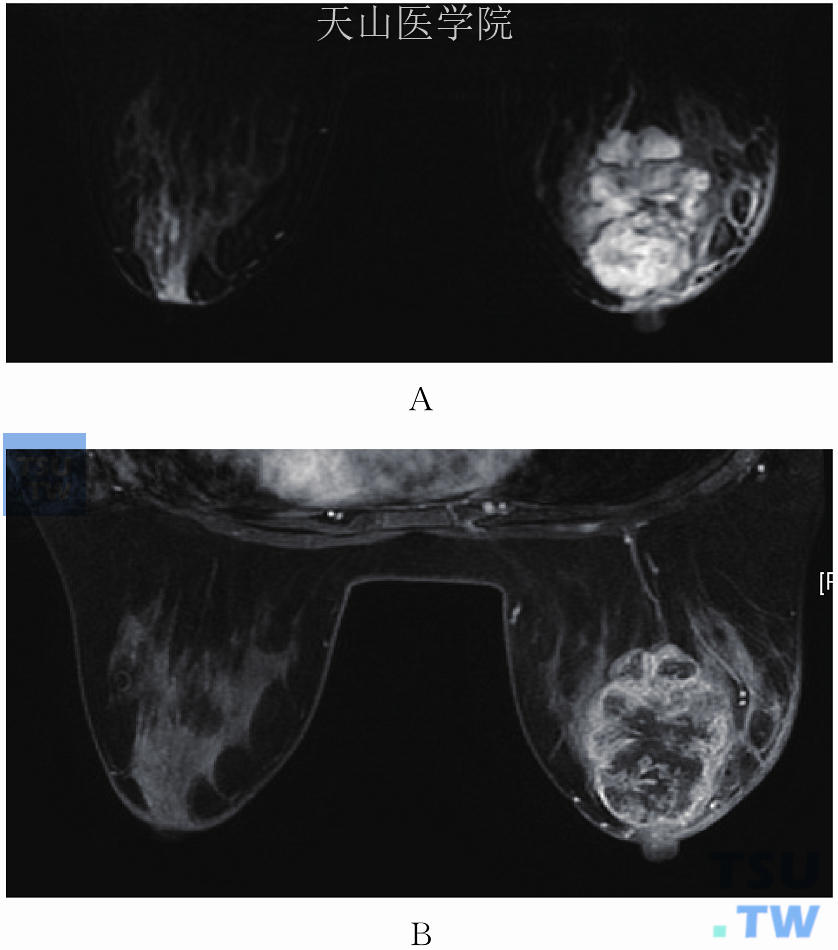 右乳腺样囊腺癌。（A）右乳晕后方分叶状肿瘤，边缘光整，信号不均匀，T2WI高信号内见小泡状更高信号；（B）增强后肿块不均匀强化，T2WI高信号区未见强化。右乳外侧皮肤增厚