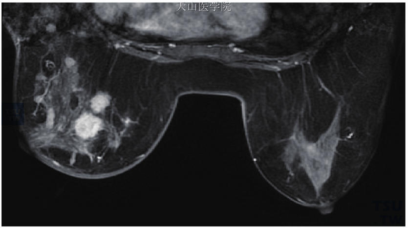 图 乳腺恶性疾病 特殊形式的乳腺癌的mri表现 乳腺肿瘤学 天山医学院